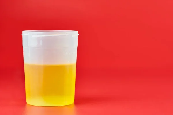Urinalysis for urolithiasis in container — Stock Photo, Image