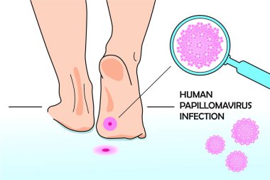 DNA virüsünün tıbbi bir örneği. İnsan papillomovirüsü. Ayaklar yere basıyor ve büyüteç altında HPV virüsü modeli.