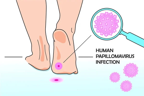 Medical Illustration Infection Dna Virus Human Papillomovirus Feet Floor Hpv — Stock Vector