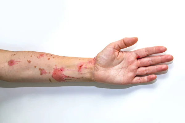 Quemaduras en la piel del brazo humano —  Fotos de Stock