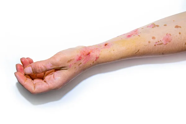 Huid brandwonden op menselijke arm — Stockfoto