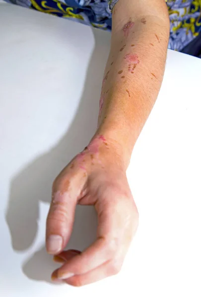 Queimaduras na pele no braço humano — Fotografia de Stock