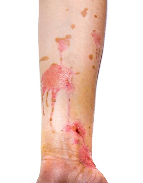 Skin burns on human arm — Stock Photo, Image