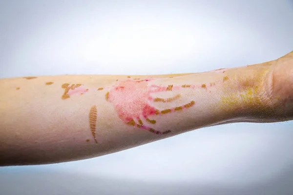 Queimaduras na pele no braço humano — Fotografia de Stock