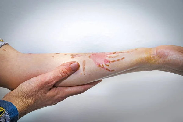 Quemaduras en la piel del brazo humano — Foto de Stock