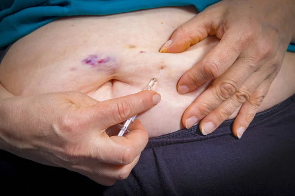 Bruises from self Injecting medical therapy — Stock Photo, Image