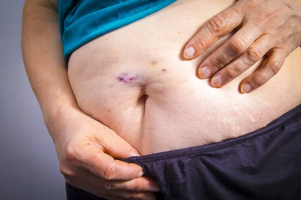 Bruises from self Injecting medical therapy — Stock Photo, Image