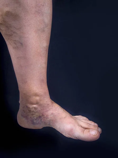Human foot with varicose veins — Stock Photo, Image