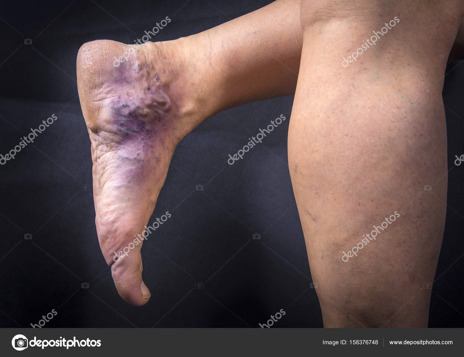 varices en los pies varices en los pies