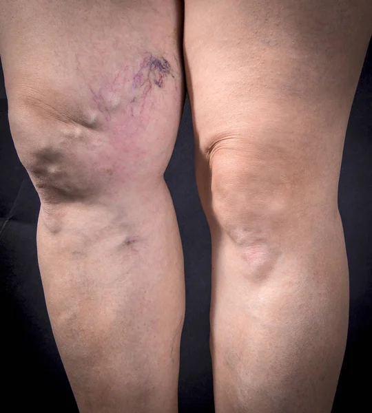 Lidské nohy s křečovými žilami — Stock fotografie