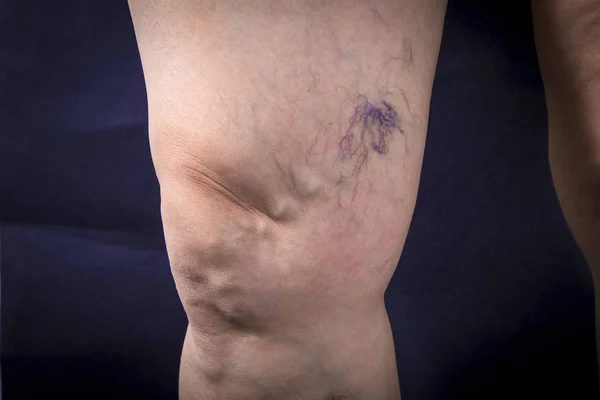Человеческая нога с варикозным расширением вен — стоковое фото
