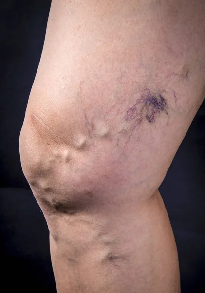 Mänskliga ben med åderbråck — Stockfoto