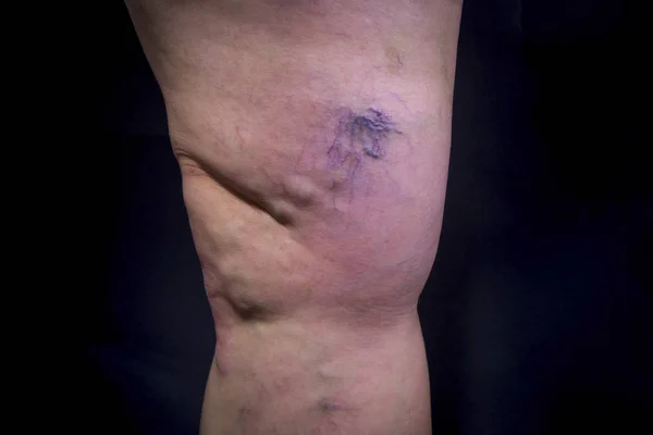 Human leg with varicose veins — Stock Photo, Image