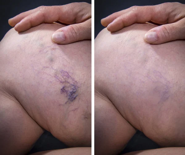 Human leg with varicose veins before and after treatment — Stock Photo, Image