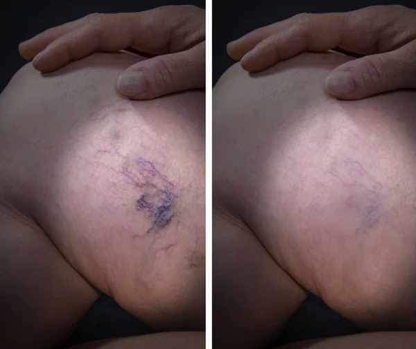 Perna humana com varizes antes e depois do tratamento — Fotografia de Stock