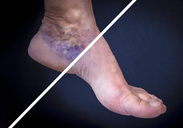 Ανθρώπινο πόδι με κιρσούς πριν και μετά — Φωτογραφία Αρχείου