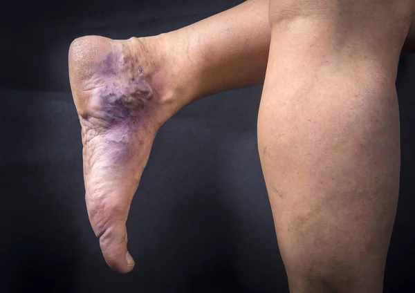 Pie humano con varices — Foto de Stock