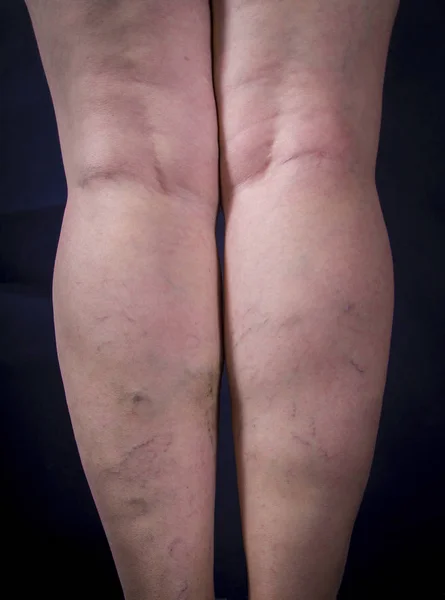Gambe umane con vene varicose — Foto Stock