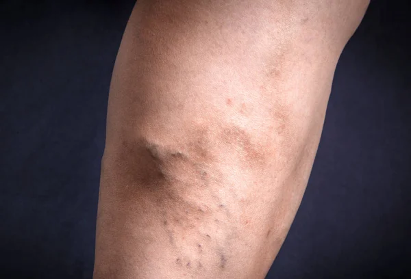 Gamba umana con vene varicose — Foto Stock