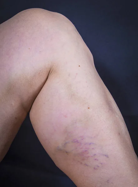 Pierna humana con varices — Foto de Stock