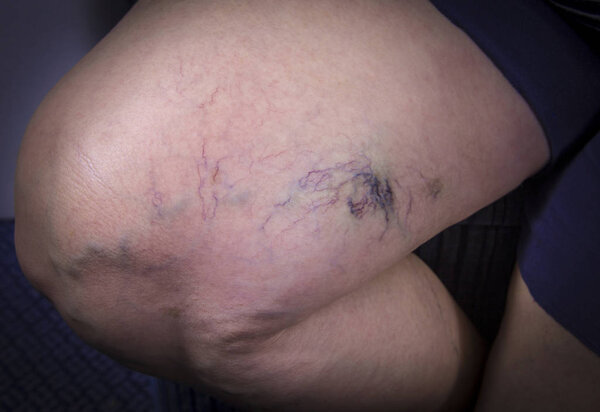 Human leg with varicose veins