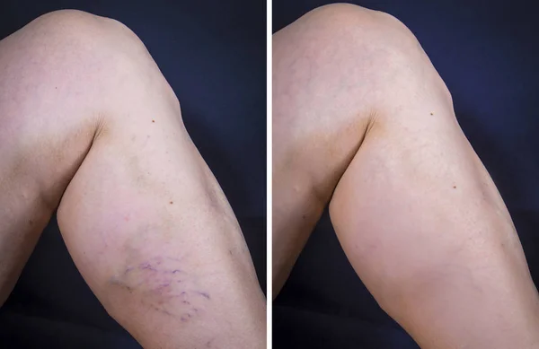 İşlemden önce ve sonra varis olan insan bacak