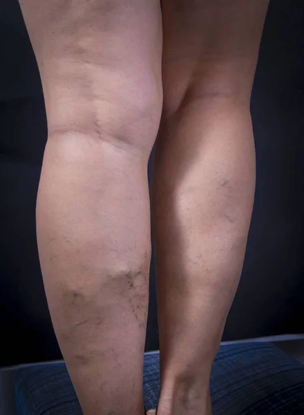 Человеческие ноги с варикозным расширением вен Стоковое Изображение
