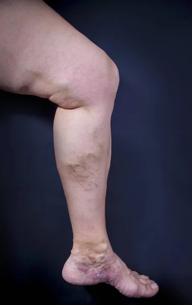 Человеческая нога с варикозным расширением вен Лицензионные Стоковые Изображения