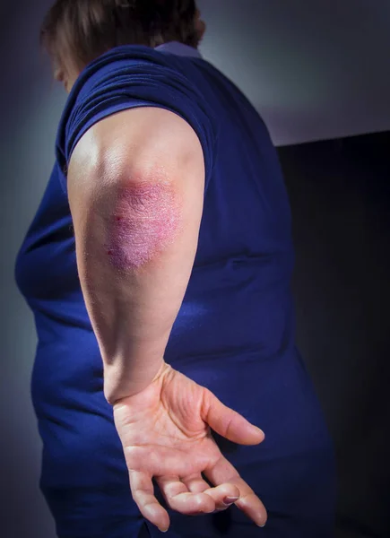 Psoriasis on elbow — Stock Photo, Image