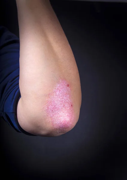Psoriasis sur coude — 图库照片