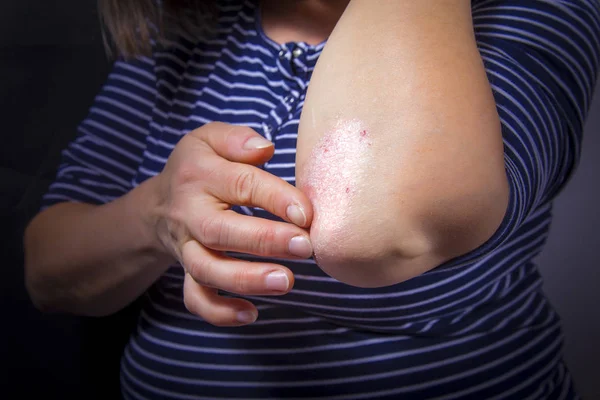 Psoriasis en el codo — Foto de Stock