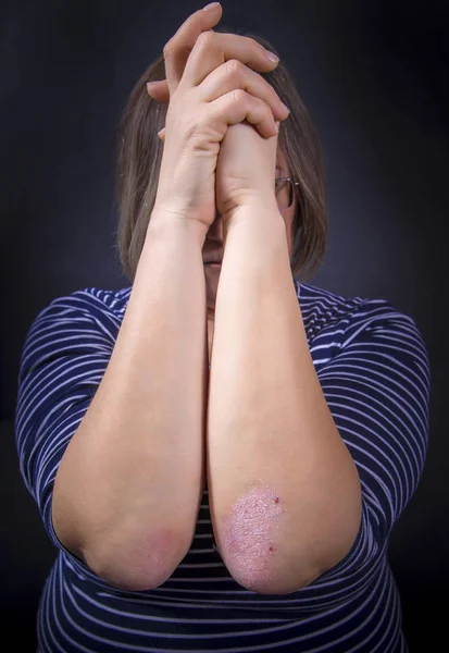 Psoriasis on elbow — Stock Photo, Image