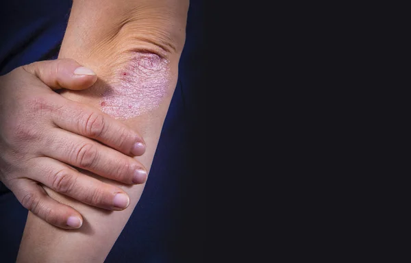 Psoriasis on elbow — Stock Photo, Image