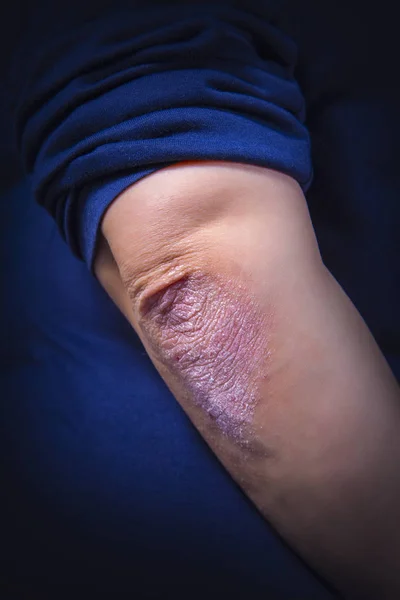 Psoriasis sur coude — 图库照片
