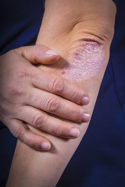 Psoriasis sur coude — 图库照片