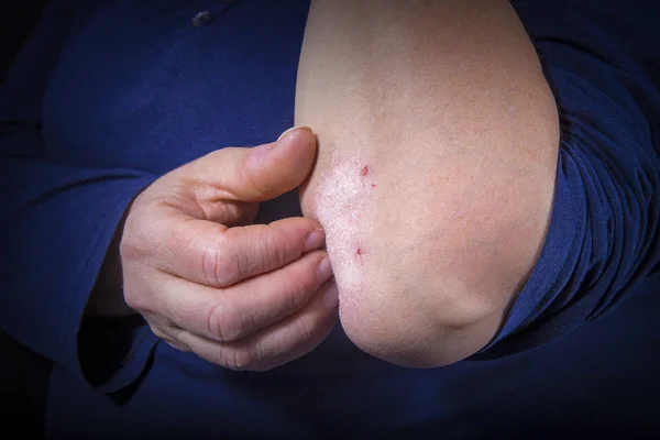 Psoriasis on elbow — Stock Photo, Image