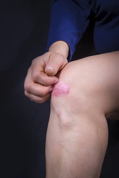 Псориаз на колене Ледис — стоковое фото