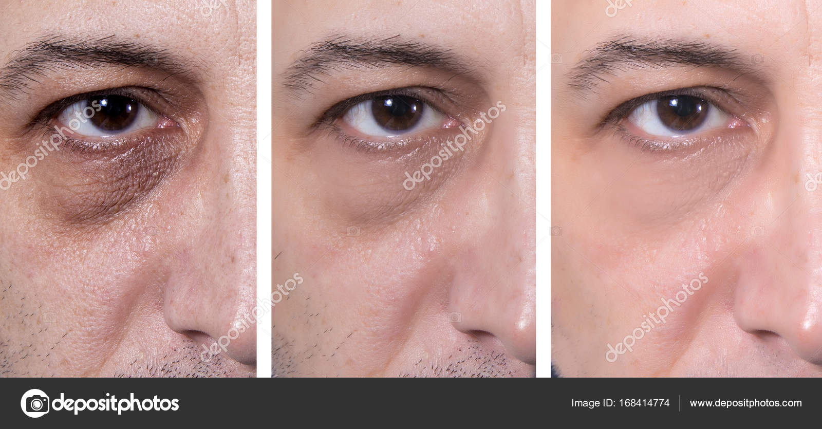 dark eye area treatment