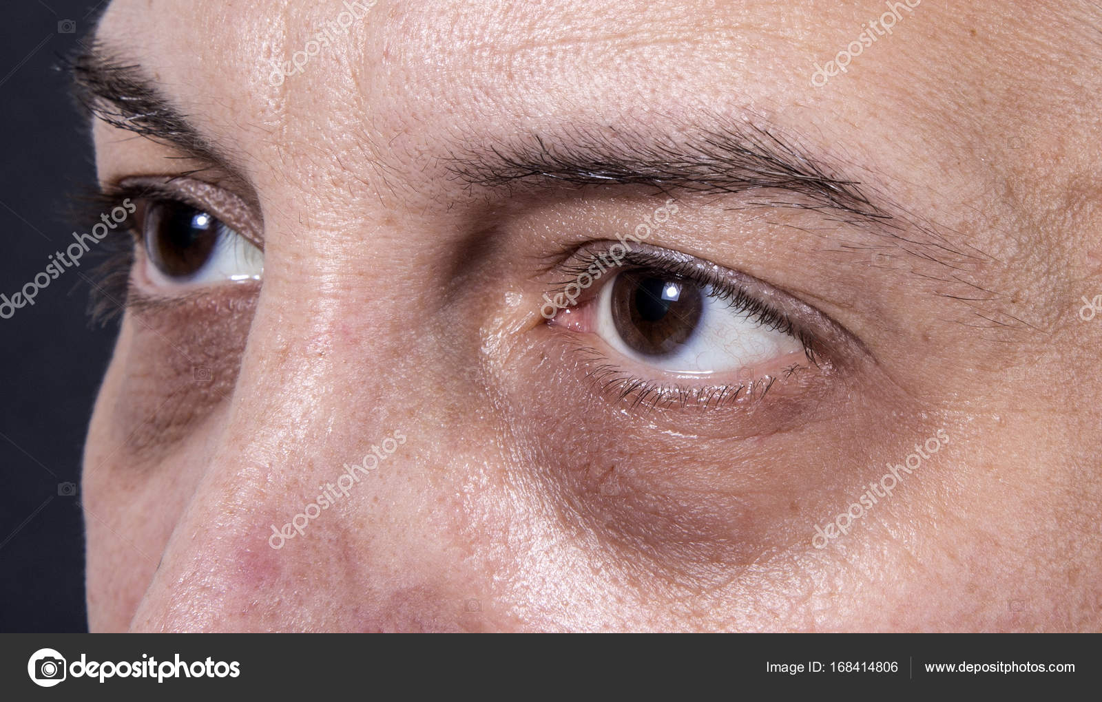 Впалые синяки под глазами. Резко появились синяки под глазами. Круги под глазами. Синяки под глазами причины. Резко появились синяки под глазами.