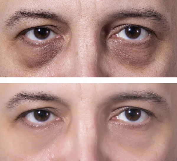 Leczenie okręgi oczu ciemne - przed i po — Zdjęcie stockowe