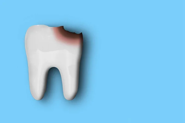 Biały model zęba z uszkodzeniem od próchnicy, izolowany na niebieskim grzbiecie — Zdjęcie stockowe