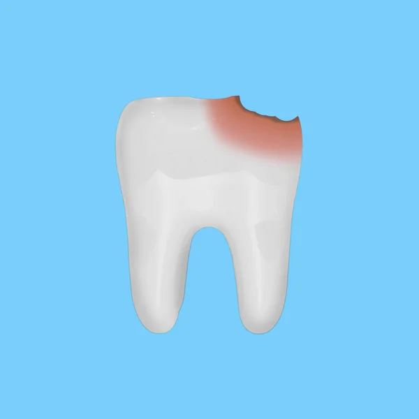 Modèle de dent blanche avec dommages causés par la carie, isolé sur fond bleu. Concept de soins et de santé dentaire. Objet pour votre projet ou design . — Photo