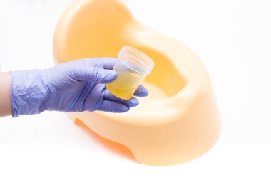 Mavi tek kullanımlık tıbbi eldiveni olan kadın eli sarı tencerenin arka planındaki bir kavanoz idrarı boşaltır. Klinik analiz için idrar toplar.
