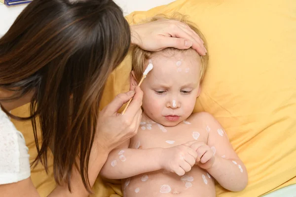 Varicella virüsü ya da suçiçeği kızarıklığı.