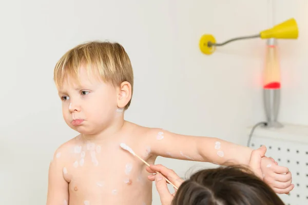 Varicella virus eller vattkoppor bubbla utslag på pojke — Stockfoto