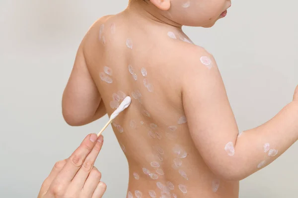 Varicella virus eller vattkoppor bubbla utslag på pojke — Stockfoto