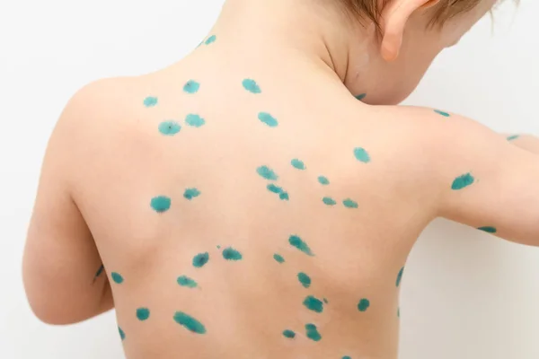 Varicella virus or Chickenpox bubble rash on boy — 스톡 사진