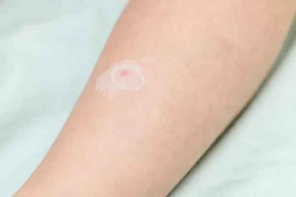 Close-up of a small child's leg with chickenpox virus or blistering rash covering red spots with calamine zinc lotion. The concept of quarantine in kindergarten — 스톡 사진