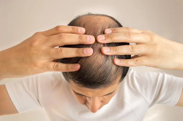 Man with hair loss — Stock Photo, Image