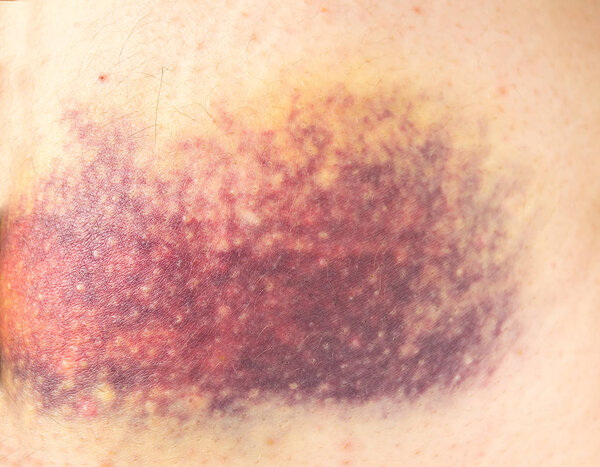 закрытый ушиб ноги
